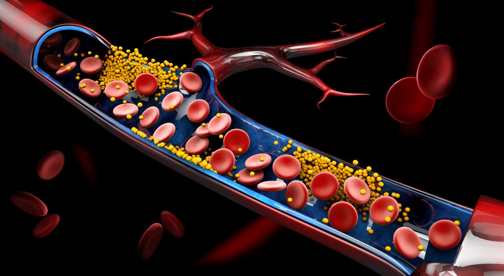 Correcting Abnormal Blood Lipid Levels - Nutrition, Supplements, and Lifestyle